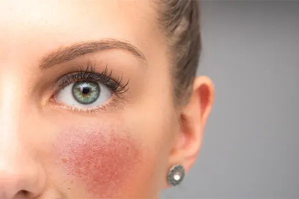 Close-up of a woman with rosacea on her cheeks. Schedule treatment for rosacea from Tanya Zboril, NP of TBT Medical in Ottawa–Gatineau.